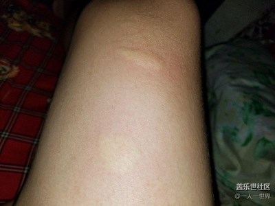 被蚊子親了倆口