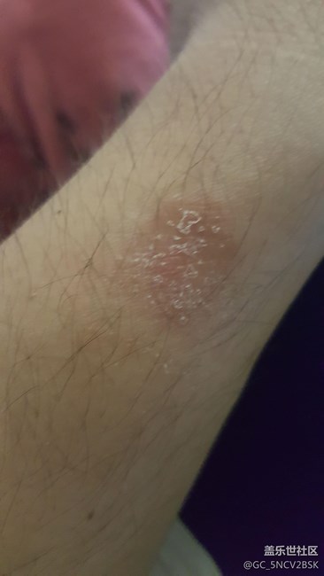 我的s3摘下來(lái)手腕起了好多泡