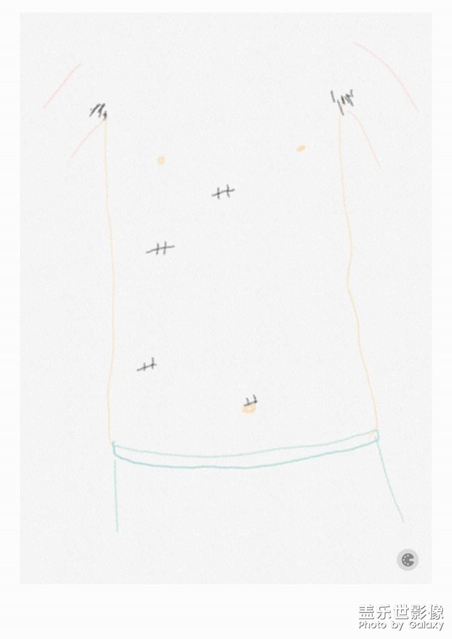 拆線過后一身輕松